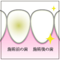 施術前の歯・施術後の歯