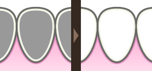 ホワイトニングイメージ